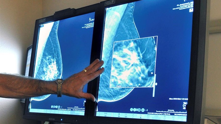 Le dépistage précoce du cancer du sein permettrait d'économiser des millions