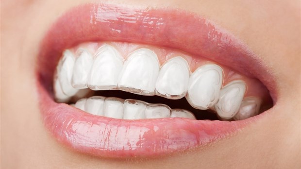 Les aligneurs transparents : une solution esthétique pour des dents droites