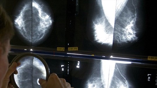 La pandémie n'a pas eu d'impacts sur les dépistages tardifs du cancer